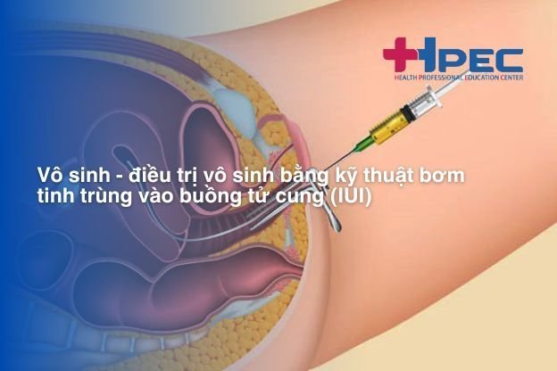 Vô sinh - điều trị vô sinh bằng kỹ thuật bơm tinh trùng vào buồng tử cung (IUI)